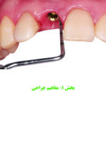 راهبردهای جلوگیری از تحلیل استخوان در ایمپلنت - Image 3