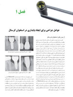 راهبردهای جلوگیری از تحلیل استخوان در ایمپلنت - Image 4