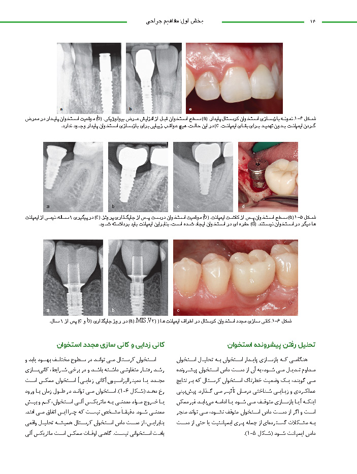 20Pages from راهبردهای جلوگیری از تحلیل استخوان در ایمپلنت_Page_14 راهبردهای جلوگیری از تحلیل استخوان در ایمپلنت - Image 5