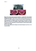 Clinical and Biomimetic Strategies for Dental Implantation in Insufficient Bone Volume Conditions 2025 - Image 3