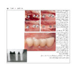 اطلس راهنمای گام به گام جراحی ایمپلنت در دندانپزشکی - Image 7