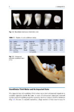 Extraction of the Mandibular Third Molar: An Evidence-based Guide 2025 - Image 2