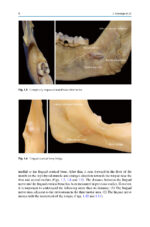 Extraction of the Mandibular Third Molar: An Evidence-based Guide 2025 - Image 3