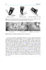Extraction of the Mandibular Third Molar: An Evidence-based Guide 2025 - Image 5