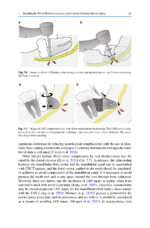Extraction of the Mandibular Third Molar: An Evidence-based Guide 2025 - Image 6