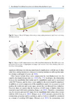 Extraction of the Mandibular Third Molar: An Evidence-based Guide 2025 - Image 6