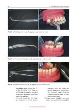 Advanced Strategies for Tooth Extraction in Dentistry 2024 - Image 17