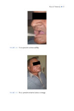 Local and Regional Flaps in Oral Cavity Cancer Reconstruction: A Case-Based Approach 2026 - Image 3