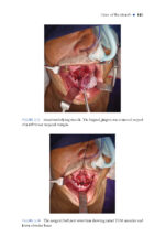 Local and Regional Flaps in Oral Cavity Cancer Reconstruction: A Case-Based Approach 2026 - Image 4