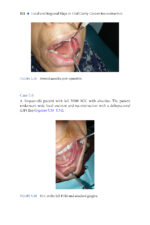 Local and Regional Flaps in Oral Cavity Cancer Reconstruction: A Case-Based Approach 2026 - Image 5