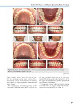 Orthodontic Aligner Treatment 2021 - Image 5