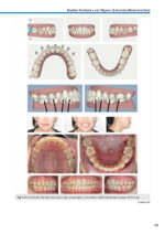 Orthodontic Aligner Treatment 2021 - Image 6