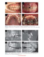 Clinical Insertion Techniques of Orthodontic Temporary Anchorage 2024 - Image 2