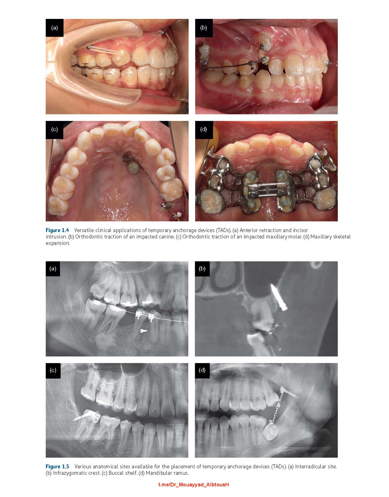 Clinical Insertion Techniques of Orthodontic Temporary Anchorage 2024 - Image 2