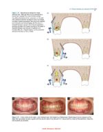 Clinical Insertion Techniques of Orthodontic Temporary Anchorage 2024 - Image 8