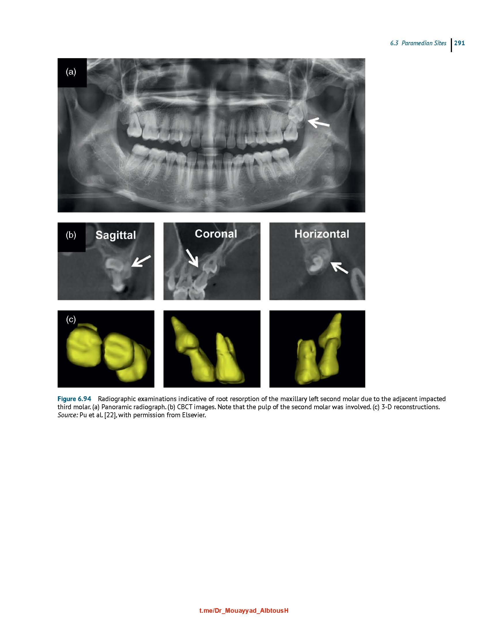 Clinical Insertion Techniques of Orthodontic Temporary Anchorage 2024 - Image 4