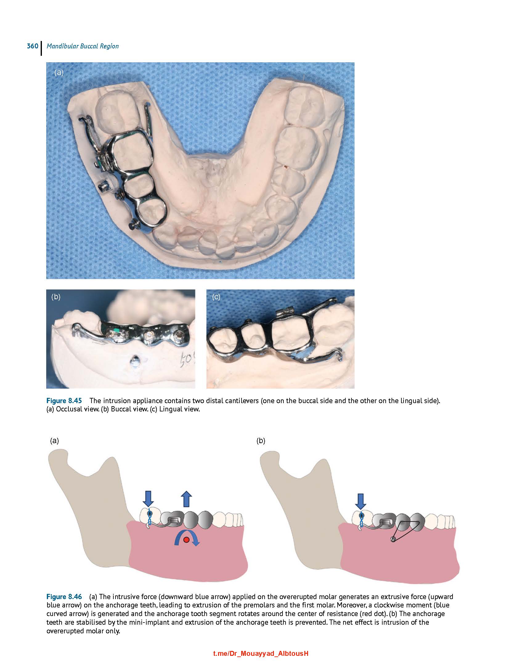 Clinical Insertion Techniques of Orthodontic Temporary Anchorage 2024 - Image 3