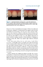 Debonding and Fixed Retention in Orthodontics: An Evidence-Based Clinical Guide 2024 - Image 7