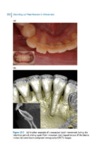 Debonding and Fixed Retention in Orthodontics: An Evidence-Based Clinical Guide 2024 - Image 2