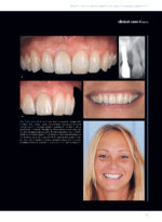 Soft Tissues & Pink Esthetics in Implant Therapy - Image 11