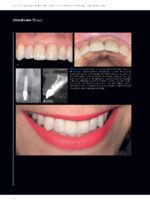 Soft Tissues & Pink Esthetics in Implant Therapy - Image 12