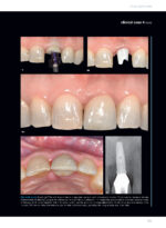 Soft Tissues & Pink Esthetics in Implant Therapy - Image 13