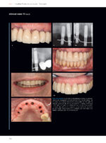Soft Tissues & Pink Esthetics in Implant Therapy - Image 14