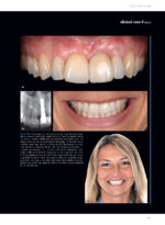 Soft Tissues & Pink Esthetics in Implant Therapy - Image 4