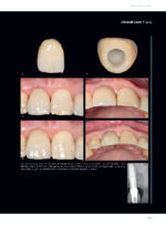 Soft Tissues & Pink Esthetics in Implant Therapy - Image 5