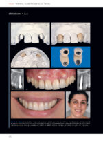 Soft Tissues & Pink Esthetics in Implant Therapy - Image 8