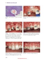 Bone and Soft Tissue Augmentation in Implantology 2022 - Image 2