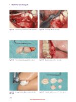 Bone and Soft Tissue Augmentation in Implantology 2022 - Image 4