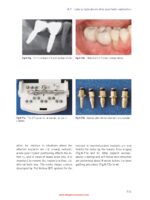 Bone and Soft Tissue Augmentation in Implantology 2022 - Image 6