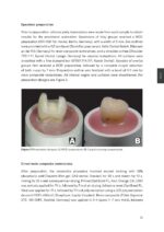 Considerations for long term clinical performance of partial restorations 2023 - Image 5