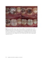Considerations for long term clinical performance of partial restorations 2023 - Image 4