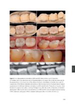 Considerations for long term clinical performance of partial restorations 2023 - Image 3