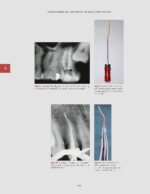 Management of Endodontic Complications From Diagnosis to Prognosis 2023 - Image 2