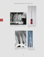 Management of Endodontic Complications From Diagnosis to Prognosis 2023 - Image 2