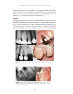 Management of Endodontic Complications From Diagnosis to Prognosis 2023 - Image 5