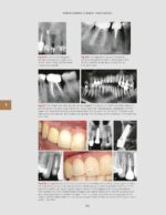 Management of Endodontic Complications From Diagnosis to Prognosis 2023 - Image 6