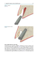 Partial Extraction Therapy in Implant Dentistry 2020 - Image 2