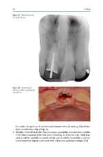 Partial Extraction Therapy in Implant Dentistry 2020 - Image 9