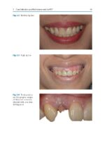 Partial Extraction Therapy in Implant Dentistry 2020 - Image 8