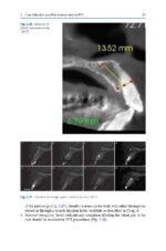 Partial Extraction Therapy in Implant Dentistry 2020 - Image 7
