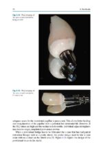 Partial Extraction Therapy in Implant Dentistry 2020 - Image 6