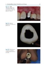 Partial Extraction Therapy in Implant Dentistry 2020 - Image 5