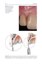 Partial Extraction Therapy in Implant Dentistry 2020 - Image 4
