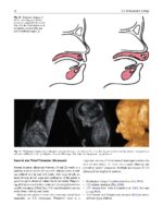 Surgical Atlas of Cleft Palate and Palatal Fistulae 2022 - Image 7