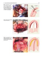 Surgical Atlas of Cleft Palate and Palatal Fistulae 2022 - Image 5