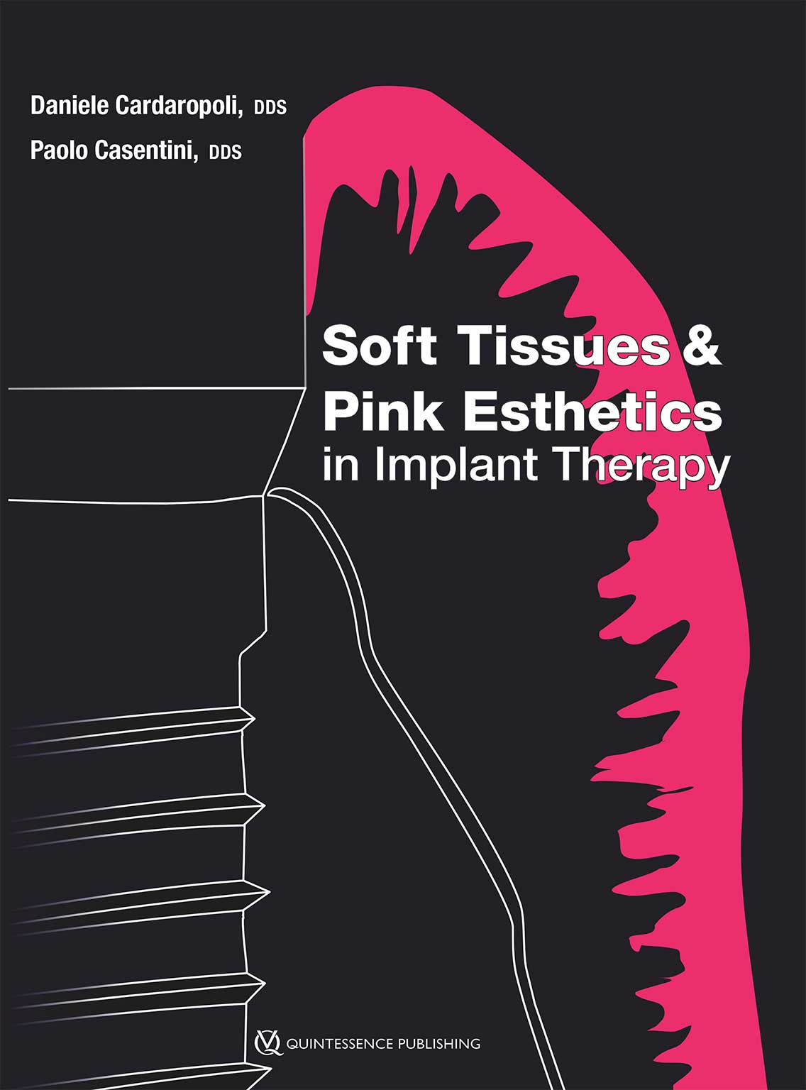 Soft-Tissues-and-Pink-Esthetics-in-Implant-Therapy-2020 Soft Tissues & Pink Esthetics in Implant Therapy - Image 1